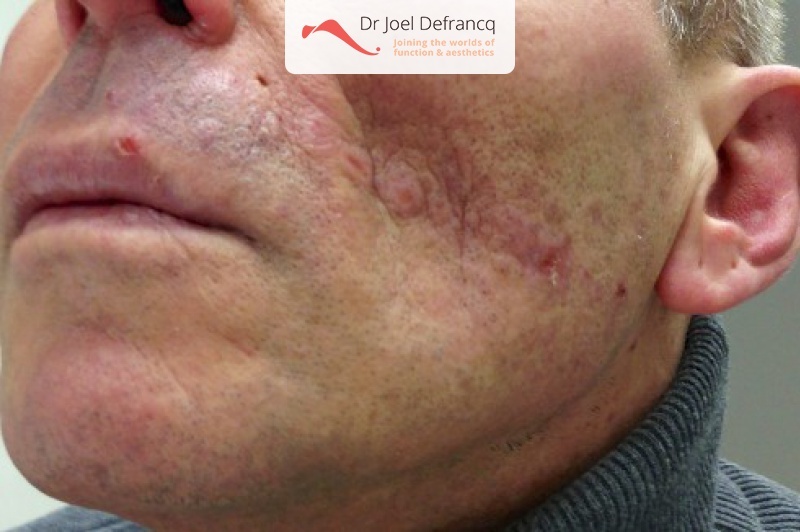 Facial Sculpture Clinic - Dr Joël Defrancq - Kaak- & aangezichtschirurgie en tandheelkundige implantaten
