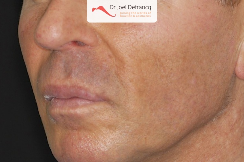 Facial Sculpture Clinic - Dr Joël Defrancq - Kaak- & aangezichtschirurgie en tandheelkundige implantaten