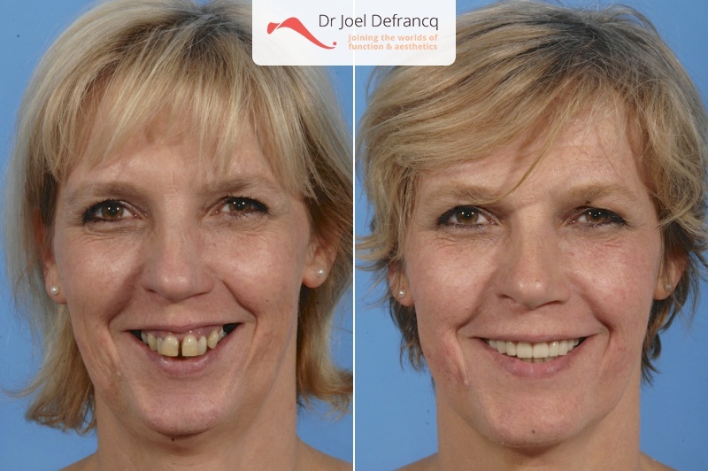 Facial Sculpture Clinic - Dr Joël Defrancq - Kaak- & aangezichtschirurgie en tandheelkundige implantaten