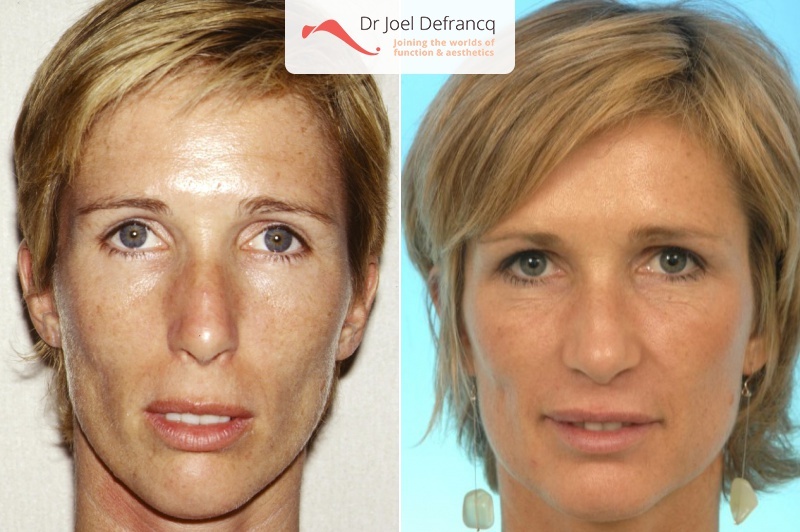 Facial Sculpture Clinic - Dr Joël Defrancq - Kaak- & aangezichtschirurgie en tandheelkundige implantaten