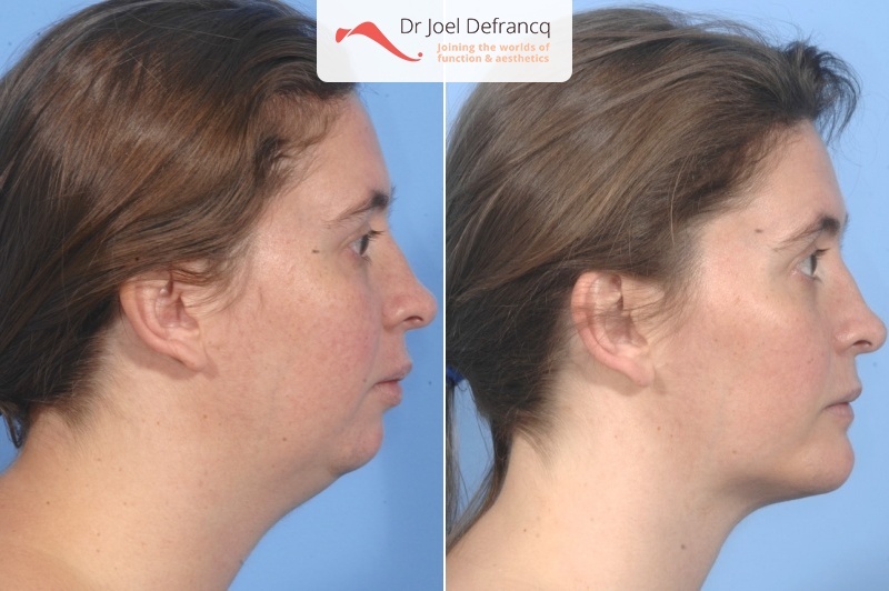 Facial Sculpture Clinic - Dr Joël Defrancq - Kaak- & aangezichtschirurgie en tandheelkundige implantaten