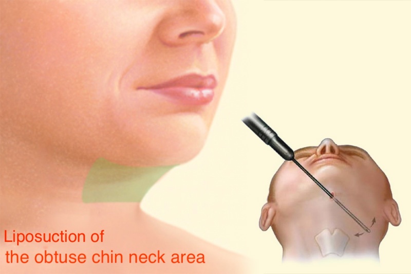 Facial Sculpture Clinic - Dr Joël Defrancq - Kaak- & aangezichtschirurgie en tandheelkundige implantaten